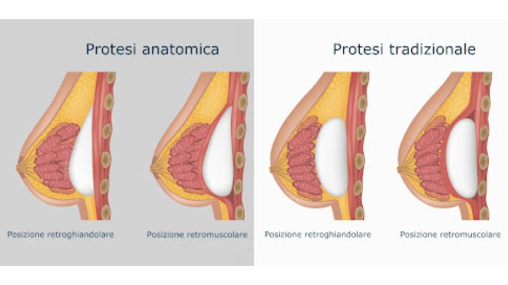 Aumento seno caratteristiche protesi mammarie
