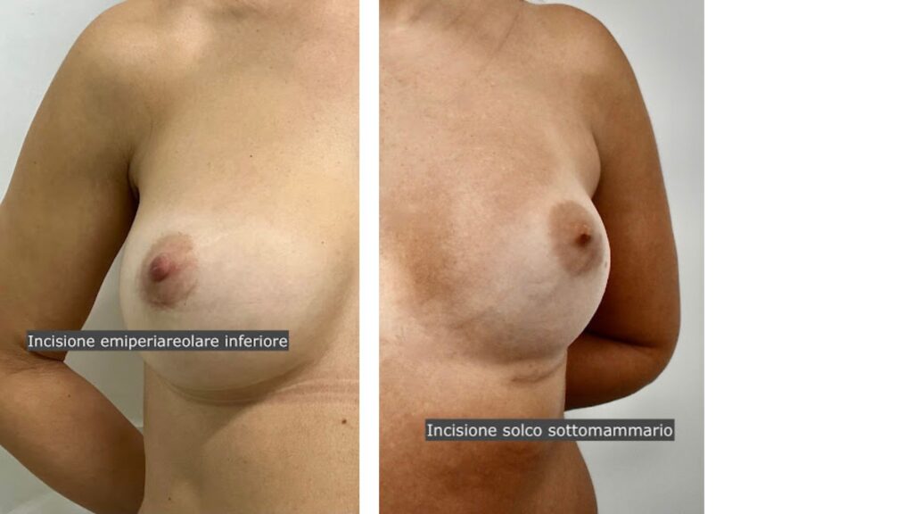 Aumento seno e tecnica chirurgica