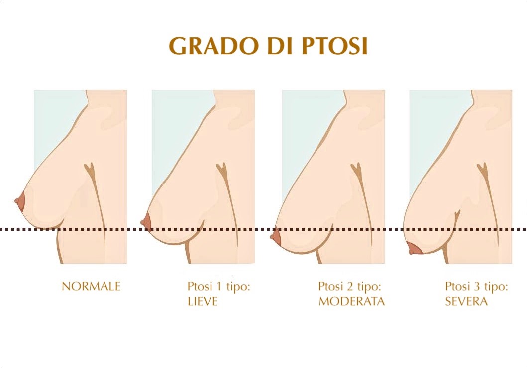 Classificazione Ptosi Mammaria - Chirurgia Deodato