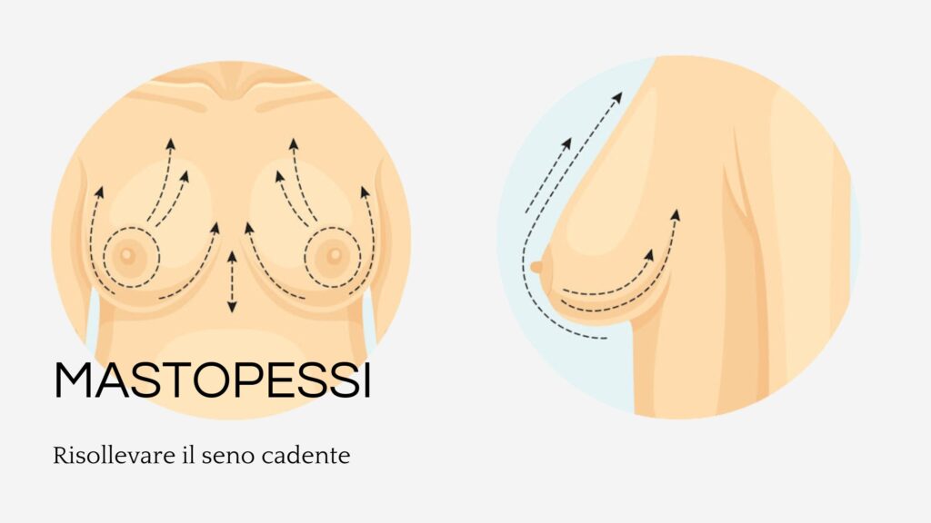 Come risollevare il seno cadente