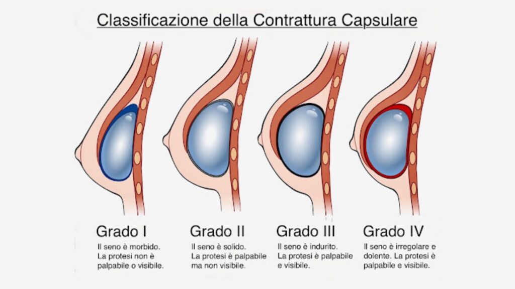 Contrattura capsulare classificazione - Chirurgia Deodato