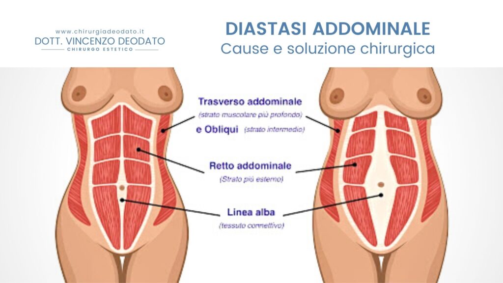 Diastasi addominale cause e soluzioni - Chirurgia Deodato