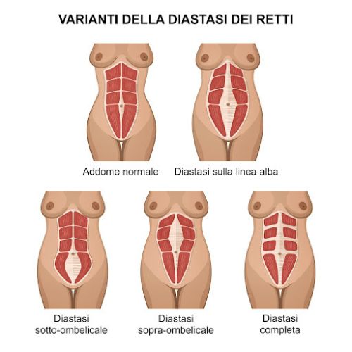 Diastasi addominale classificazione - Chirurgia Deodato