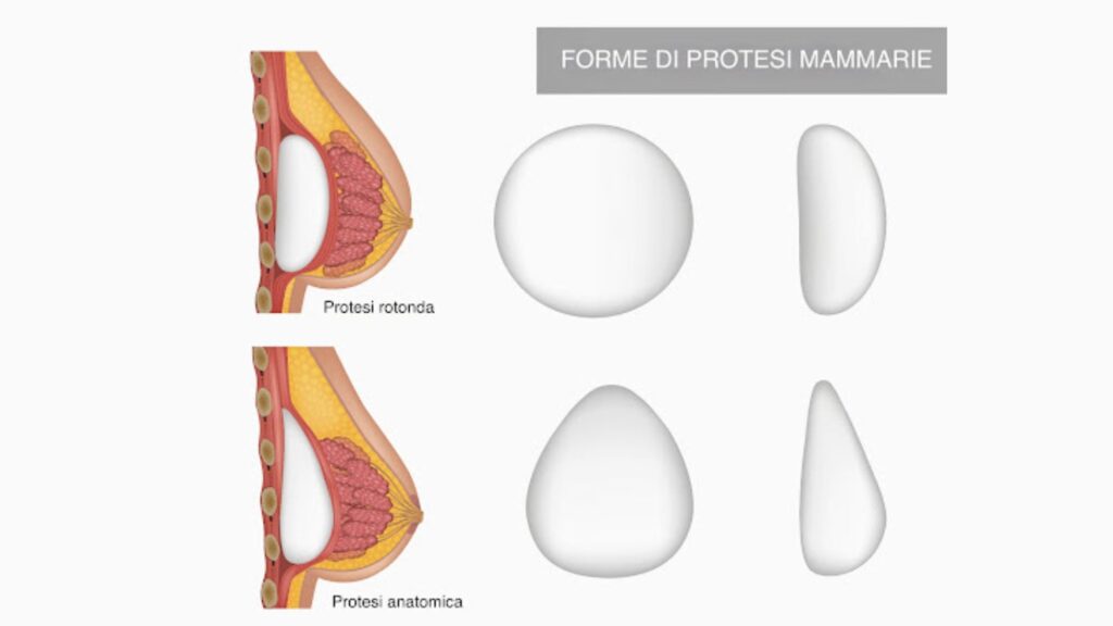 Forme di protesi mammarie