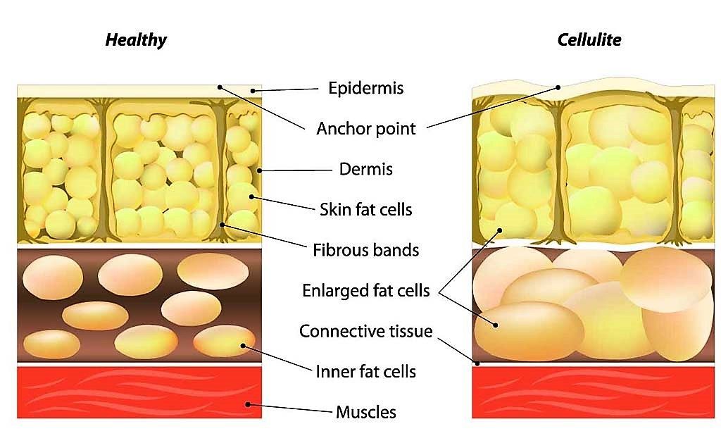 Liposuzione e tecnica tumescente per eliminare il grasso in eccesso - Chirurgia Estetica Deodato