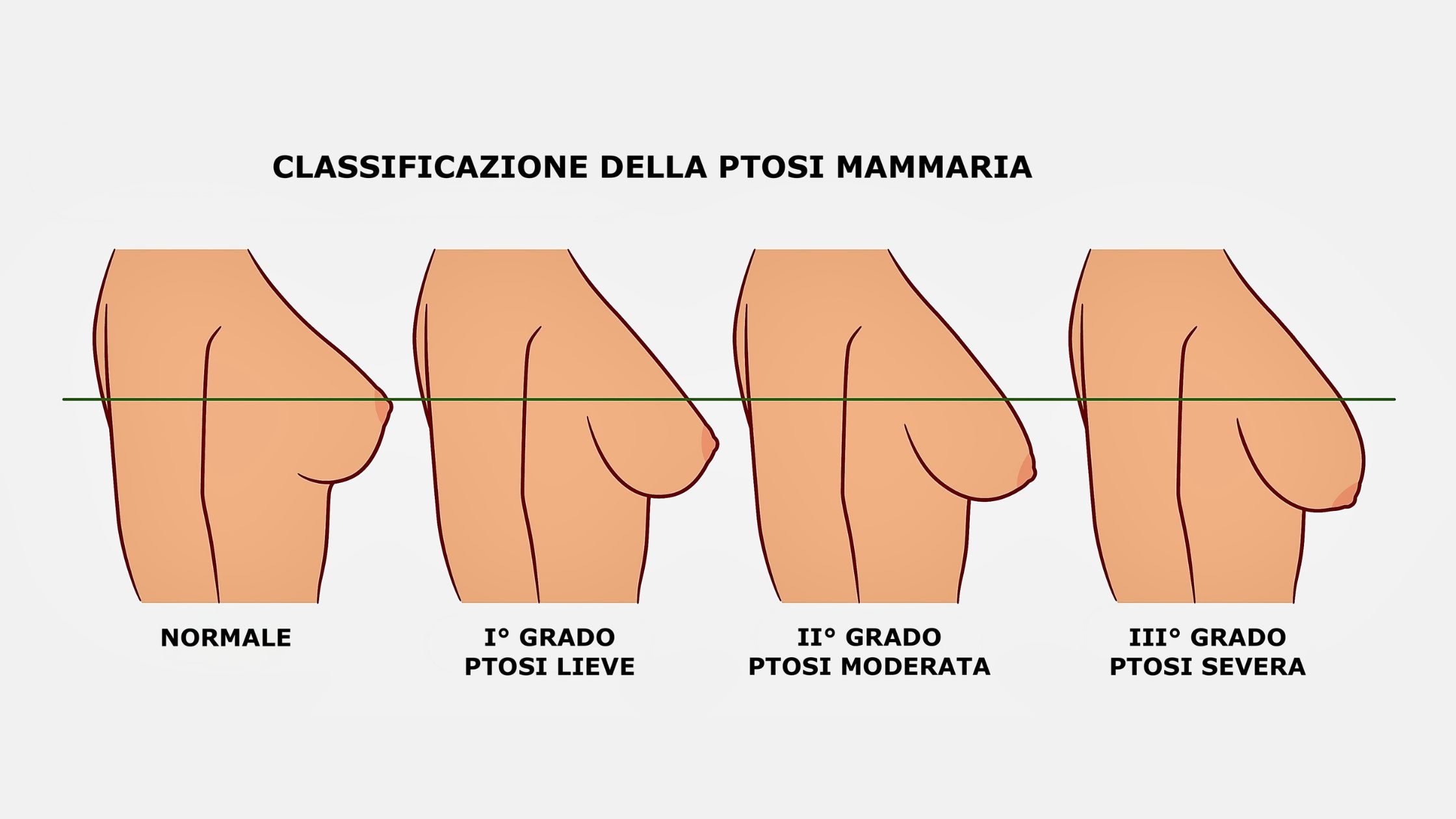 Mastopessi classificazione ptosi mammaria