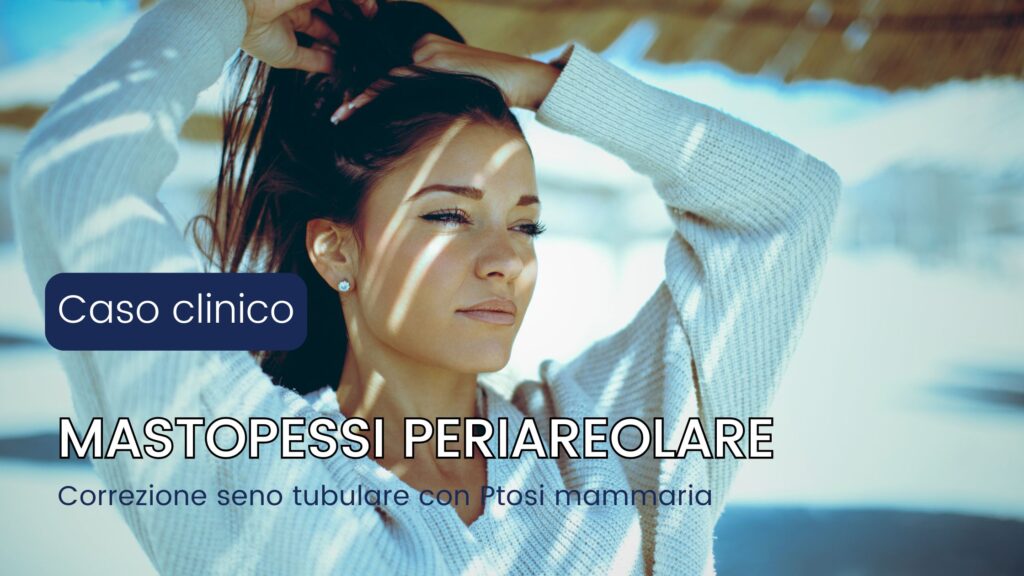 Mastopessi periareolare nel seno tubulare