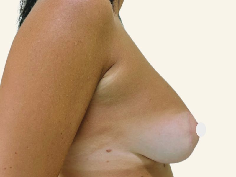 Mastopessi periareolare per seno tubulare dopo l'intervento