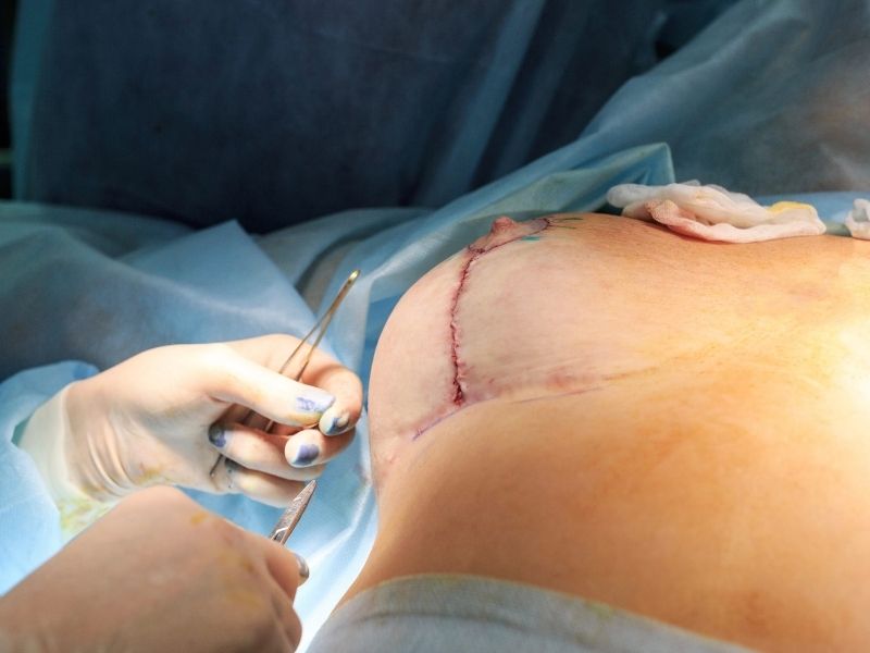 Mastoplastica riduttiva tecnica chirurgica - Chirurgia Deodato