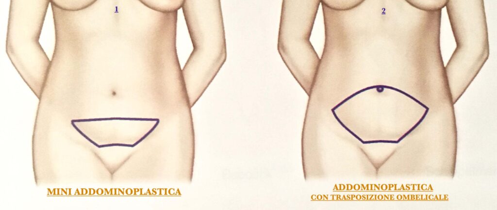 Miniaddominoplastica a altre procedure di Chirurgia Estetica addome - Chirurgia Deodato