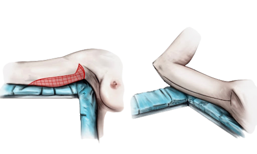 Pelle in eccesso braccia - Chirurgia Deodato