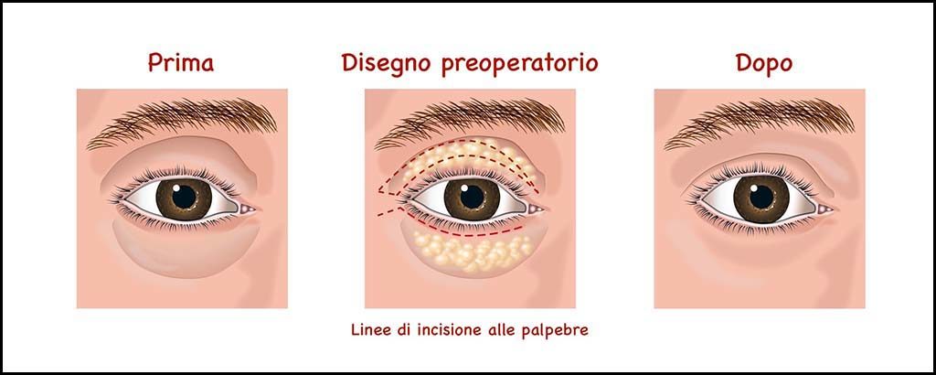 Ptosi palpebrale e blefaroplastica - Chirurgia Estetica Deodato