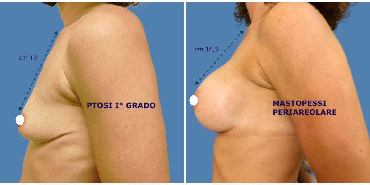 Mastoplastica Additiva con Lifting seno