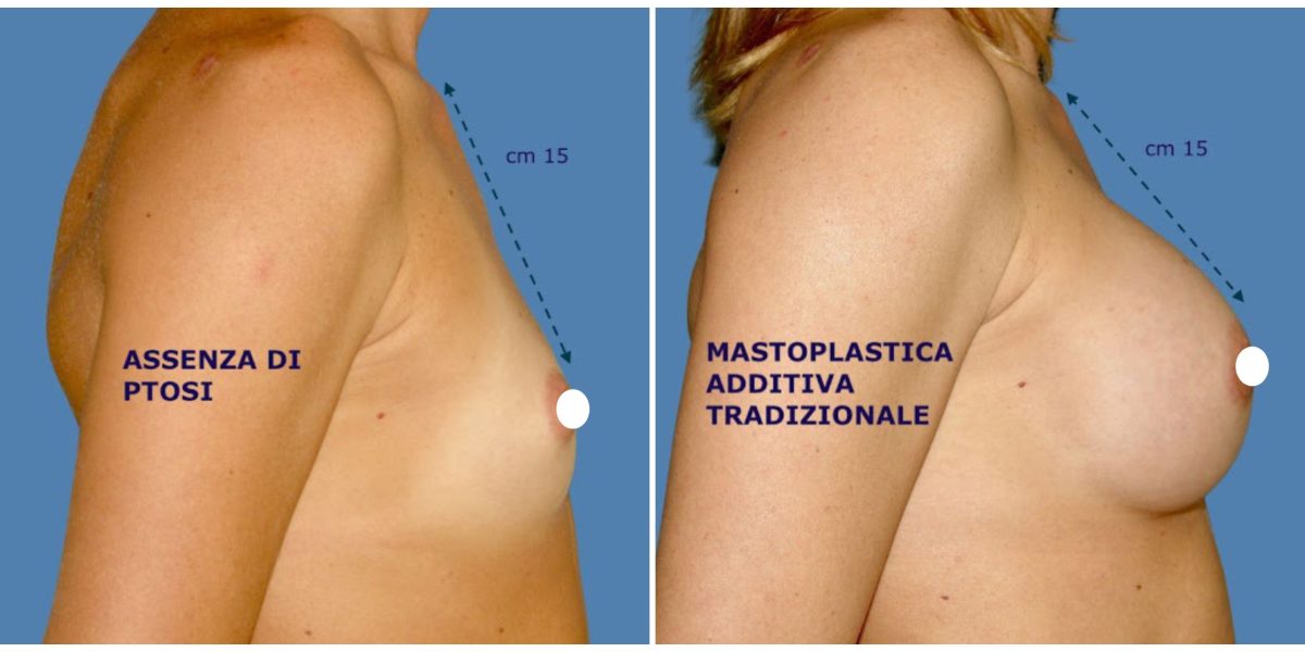 Mastoplastica Additiva tradizionale